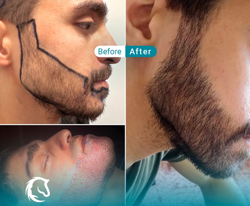 Beard Transplantation. Dr Vedat Tosun. Medhair